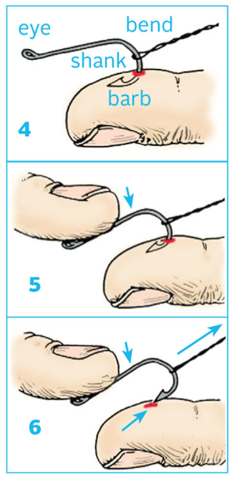 Fish hook removal and the String Yank Technique