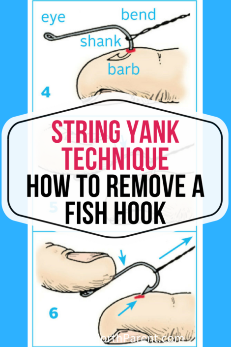 The String Yank Technique _ How to Remove a Fish Hook if You're Caught in  the Fishing Fun - Up North Parent